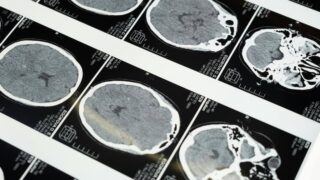 How AI might help in diagnosing mild concussions